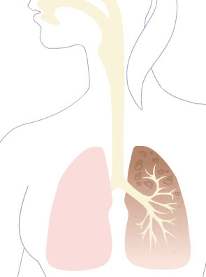 Representación de una parte del aparato respiratorio: los pulmones. Se ven los bronquios, bronquiolos y la cavidad que conecta los pulmones con la nariz y la boca.