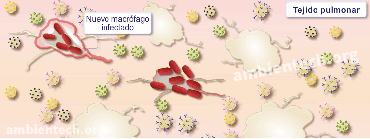 Dibujo de un tejido pulmonar donde hay macrófagos infectados por bacterias. También hay macrófagos no infectados y linfocitos. Supone una representación del inicio de la tuberculosis.