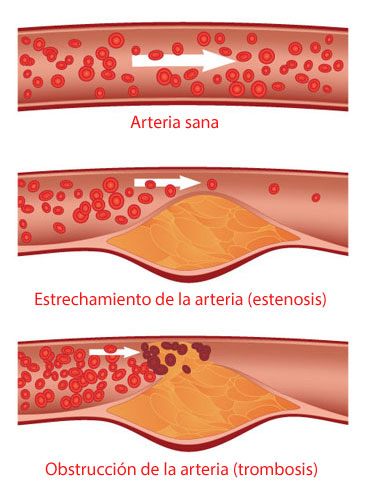 ilustración de una arteria obstruida